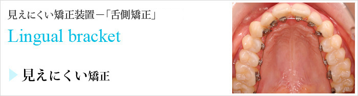 見えない矯正装置－「舌側矯正」Lingual bracket 見えない矯正