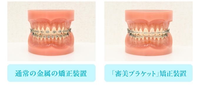 従来の金属ブラケット　最新の半透明ブラケット